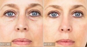under eye treatments wrinkles product